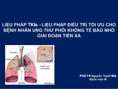 Liệu pháp TKIS - Liệu pháp điều trị tối ưu cho bệnh nhân ung thư phổi không tế bào nhỏ giai đoạn tiến xa